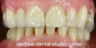 4 crowns and whitening