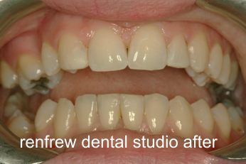 composite veneer