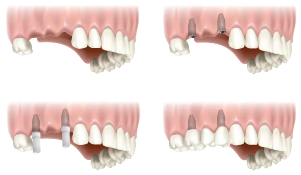 implant retained bridge