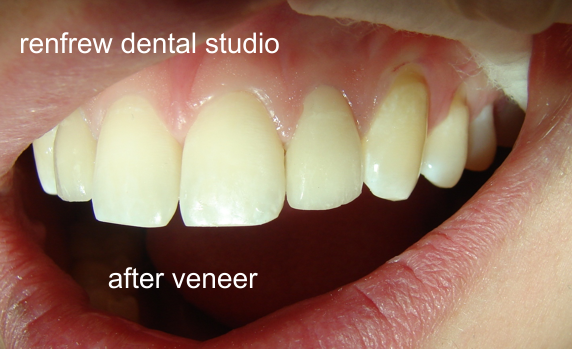 veneer