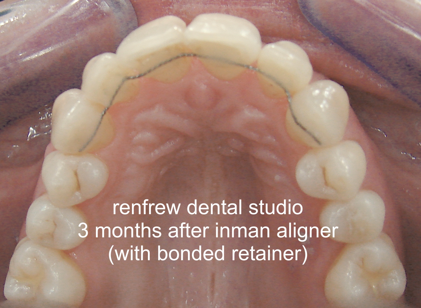 aligned teeth