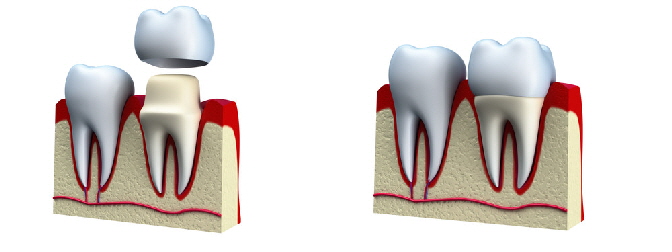 crown preparation