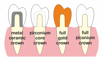 Types of dental crown